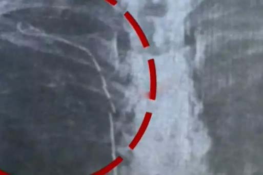  നെഞ്ചില്‍ സര്‍ജിക്കല്‍ ട്യൂബ് കുടുങ്ങി; ശസ്ത്രക്രിയാ പിഴവ് സമ്മതിച്ച് ഡോക്ടര്‍